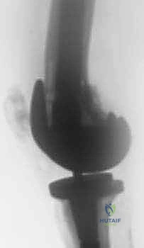 صورة توضيحية لـ جراحة مراجعة مفصل الركبة الكلي: التغلب على فقدان عظم الفخذ باستخدام الدعامات والطعوم العظمية