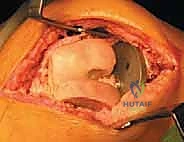 صورة توضيحية لـ جراحة مراجعة مفصل الركبة الكلي: التغلب على فقدان عظم الفخذ باستخدام الدعامات والطعوم العظمية