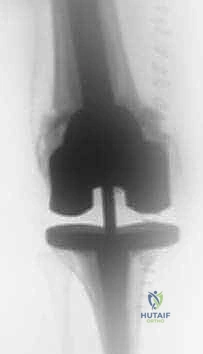 صورة شعاعية تظهر الارتخاء العقيم والانحلال العظمي