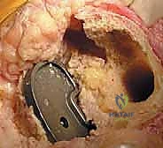 صورة توضيحية لـ جراحة مراجعة مفصل الركبة الكلي: التغلب على فقدان عظم الفخذ باستخدام الدعامات والطعوم العظمية