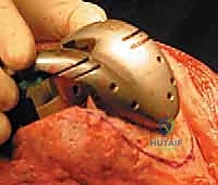 صورة توضيحية لـ جراحة مراجعة مفصل الركبة الكلي: التغلب على فقدان عظم الفخذ باستخدام الدعامات والطعوم العظمية