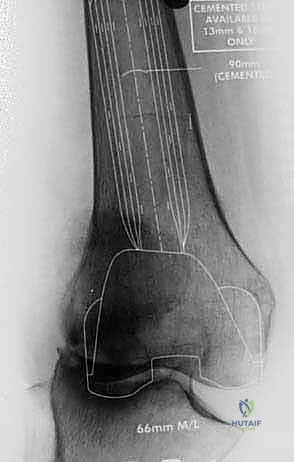 Illustration of loss metal augments - Dr. Mohammed Hutaif