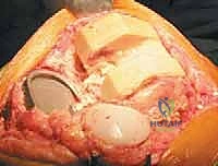 استخدام الدعامات المعدنية المعيارية في المفصل