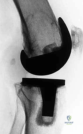 حالة كسر حول المفصل تتطلب جراحة مراجعة