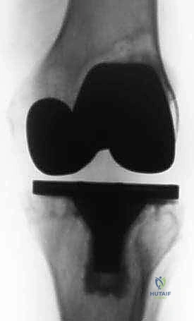 تأثير العدوى على المفصل الصناعي والعظم المحيط