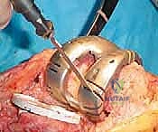 صورة توضيحية لـ جراحة مراجعة مفصل الركبة الكلي: التغلب على فقدان عظم الفخذ باستخدام الدعامات والطعوم العظمية