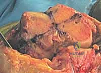 التخطيط الجراحي المسبق وتحديد قياسات المفصل