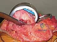 تحضير القناة النخاعية لعظم الفخذ