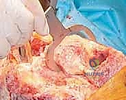 إزالة المفصل القديم والأسمنت بحذر شديد