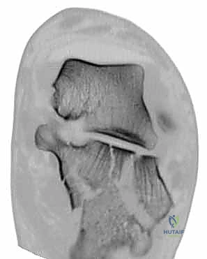الانتظار حتى زوال التورم