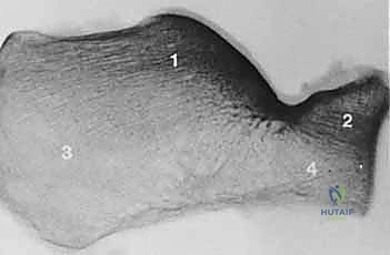 الشق الجراحي على شكل حرف L