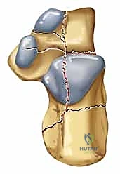تقنية عدم اللمس بالأسلاك