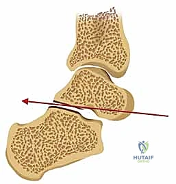 الأعراض السريرية لكسر الكعب