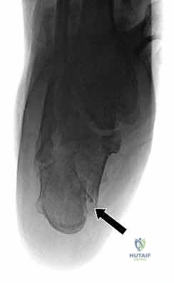 تشريح عظم الكعب والمفصل تحت الكاحل