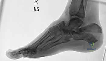 إتقان علاج كسور عظم الكعب داخل المفصل: النهج الجانبي الموسع مع الأستاذ الدكتور محمد هطيف