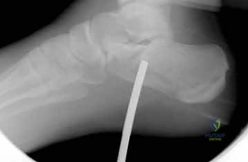 التثبيت المؤقت