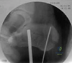 وضع الشريحة المعدنية