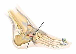 إعادة بناء المفصل