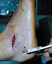 استكمال التثبيت