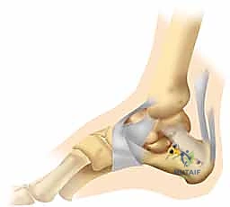 إغلاق الجرح