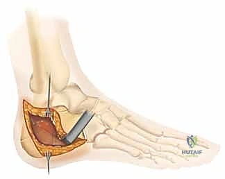 الأشعة السينية النهائية داخل العمليات