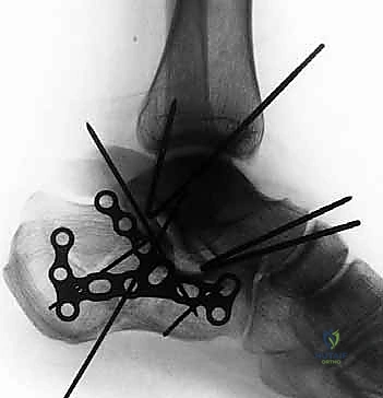 صورة مقطعية ما بعد الجراحة للتأكد من الرد