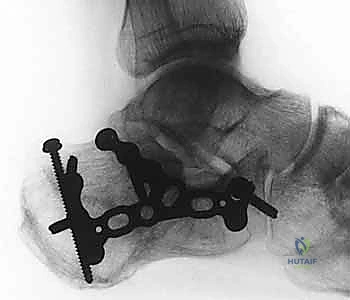 إدخال المسامير الداعمة