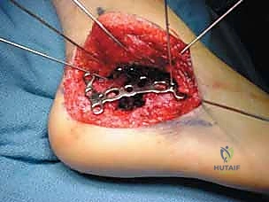 Intraoperative Surgical Step