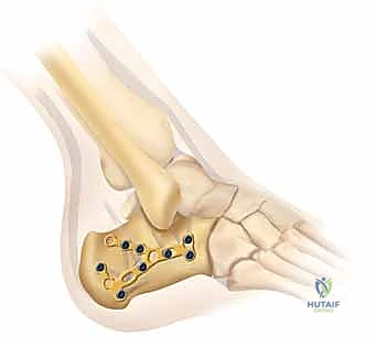 الالتئام التام للعظم