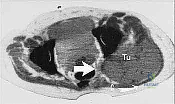 صورة شعاعية توضح تدمير الورم لعظام الحوض
