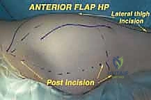 تدوير الرفرفة الأمامية لتغطية العيب الجراحي