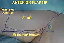تخطيط الرفرفة الأمامية قبل الجراحة