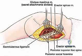 خياطة وتثبيت الرفرفة الأمامية
