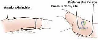 تجهيز الرفرفة الجلدية العضلية الأمامية