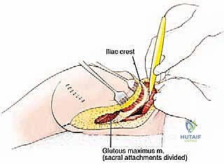 الشكل النهائي للجرح بعد الإغلاق