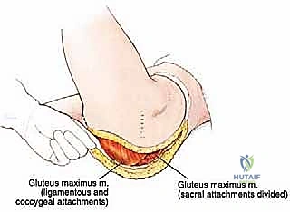 استئصال نصف الحوض بالرفرفة الأمامية: حل متقدم لأورام الحوض المعقدة مع الأستاذ الدكتور محمد هطيف في صنعاء