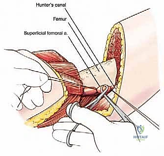 صورة الرنين المغناطيسي توضح امتداد الورم
