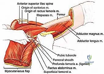 مرحلة استئصال نصف الحوض الجذري
