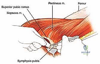 اكتمال الإغلاق الجراحي بنجاح