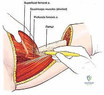 السيطرة على الأوعية الدموية الحيوية