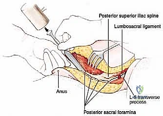 إغلاق الطبقات العضلية العميقة