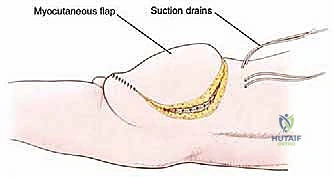 التأكد من التروية الدموية للرفرفة