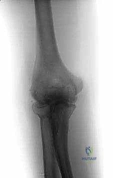 التجهيزات الجراحية المتقدمة لتنظير المرفق