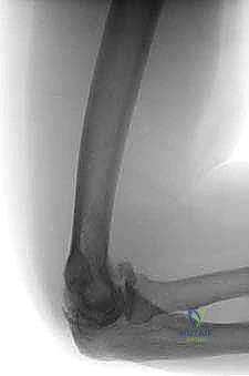 مراحل تطور خشونة المرفق وتآكل الغضاريف