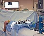 إزالة الأجسام السائبة والنتوءات العظمية بالمنظار