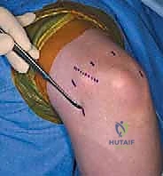 صورة توضيحية لـ تنظير مفصل المرفق لعلاج خشونة المفاصل التنكسية: دليل شامل للمرضى مع الأستاذ الدكتور محمد هطيف