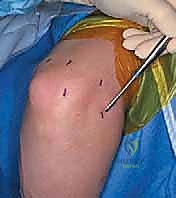 صورة توضيحية لـ تنظير مفصل المرفق لعلاج خشونة المفاصل التنكسية: دليل شامل للمرضى مع الأستاذ الدكتور محمد هطيف