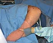 تنظير مفصل المرفق لعلاج خشونة المفاصل التنكسية: دليل شامل للمرضى مع الأستاذ الدكتور محمد هطيف