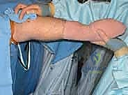 صورة توضيحية لـ تنظير مفصل المرفق لعلاج خشونة المفاصل التنكسية: دليل شامل للمرضى مع الأستاذ الدكتور محمد هطيف