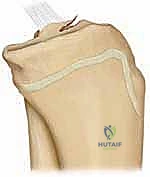 Masterclass: Arthroscopic & Open Management of Pediatric Tibial Spine Fractures